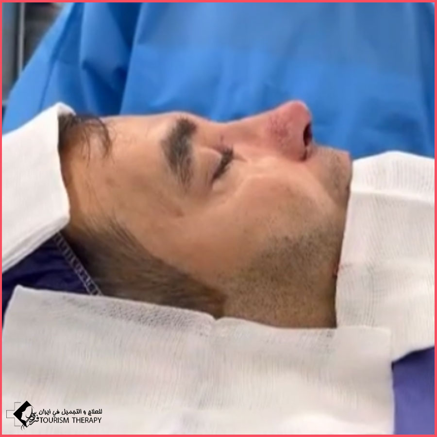 عملية تجميل الأنف | الدكتور سعيد گلبروران