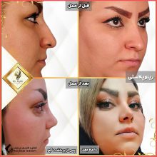 تجميل الأنف في ايران مع الدكتور سيد علي عقيلي