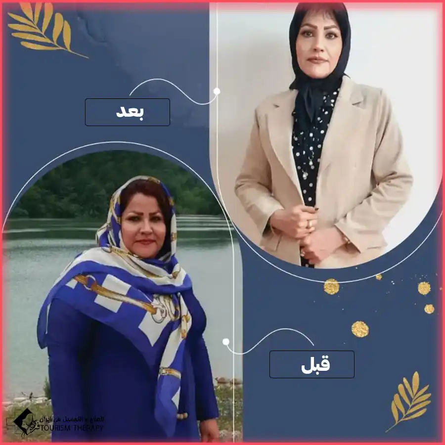 عملية ثنائي تقسيم المعدة في مشهد مع الدكتور سيد فاضل اعلمي