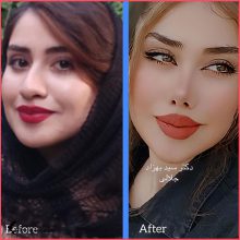 تجميل الأنف في سبزوار مع الدكتور سيد بهزاد جلالي