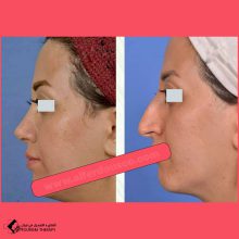 تجميل الأنف | الدكتور شهرام فاضلي