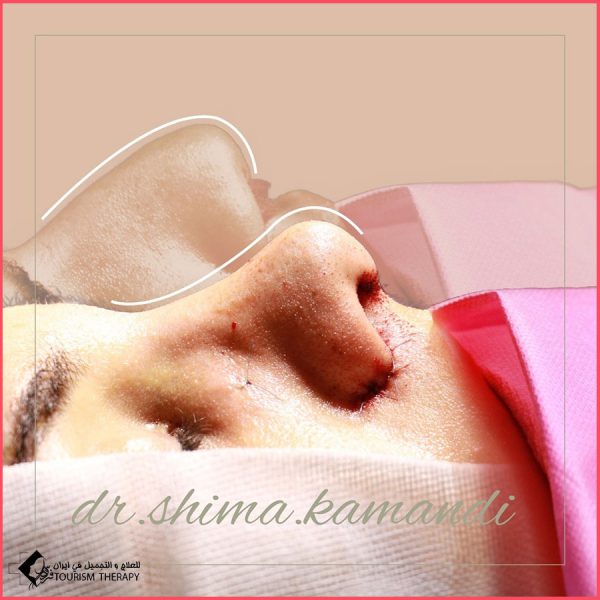 تجميل الأنف | الدكتورة شيماء كمندي
