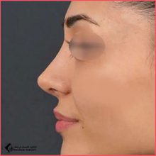 تجميل الأنف في طهران الدكتور وهاب آستركي