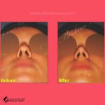 تجميل الأنف | الدكتور بيجن ربيعي