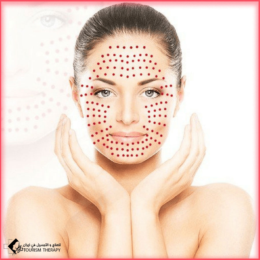Face PRP Shiraz.Iran بلازما الوجه في شيراز