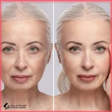 شد الوجه في مشهد مع جراح التجميل الدكتور كامران كاوياني