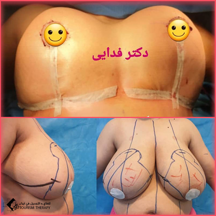 Mammoplasty Dr.Mohsen Fadaei Tehran شد وتصغير الصدر
