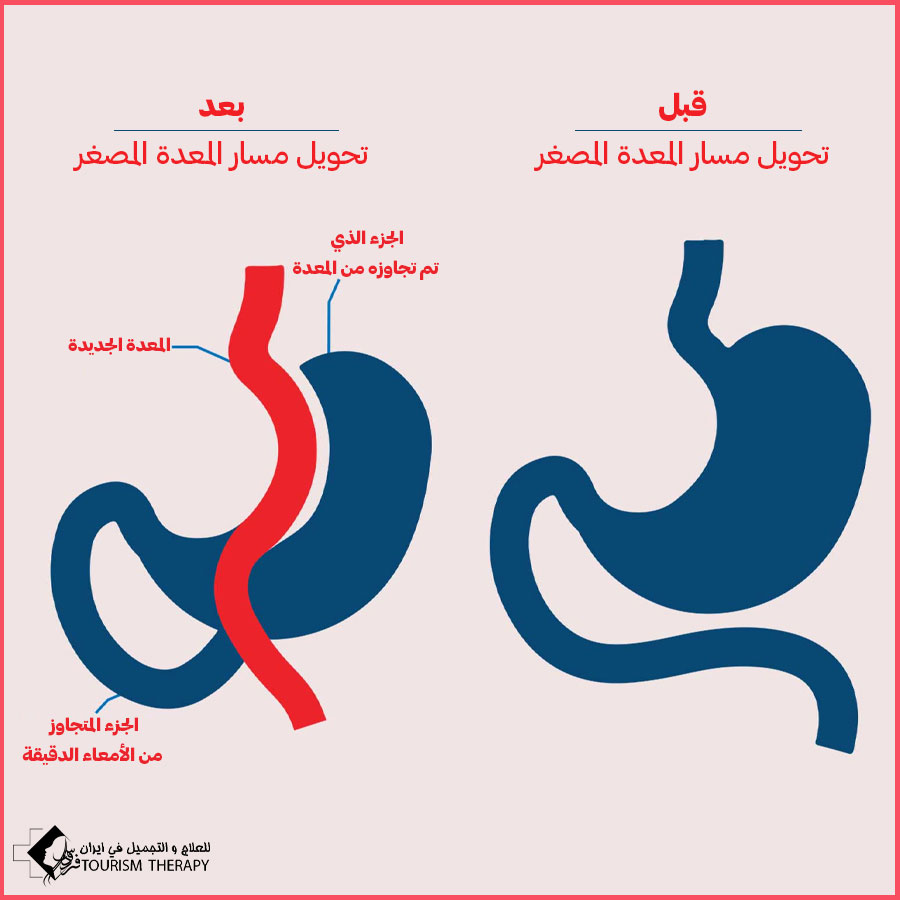 Mini Gastric Bypass Iran عملية تحويل مسار المعدة المصغر