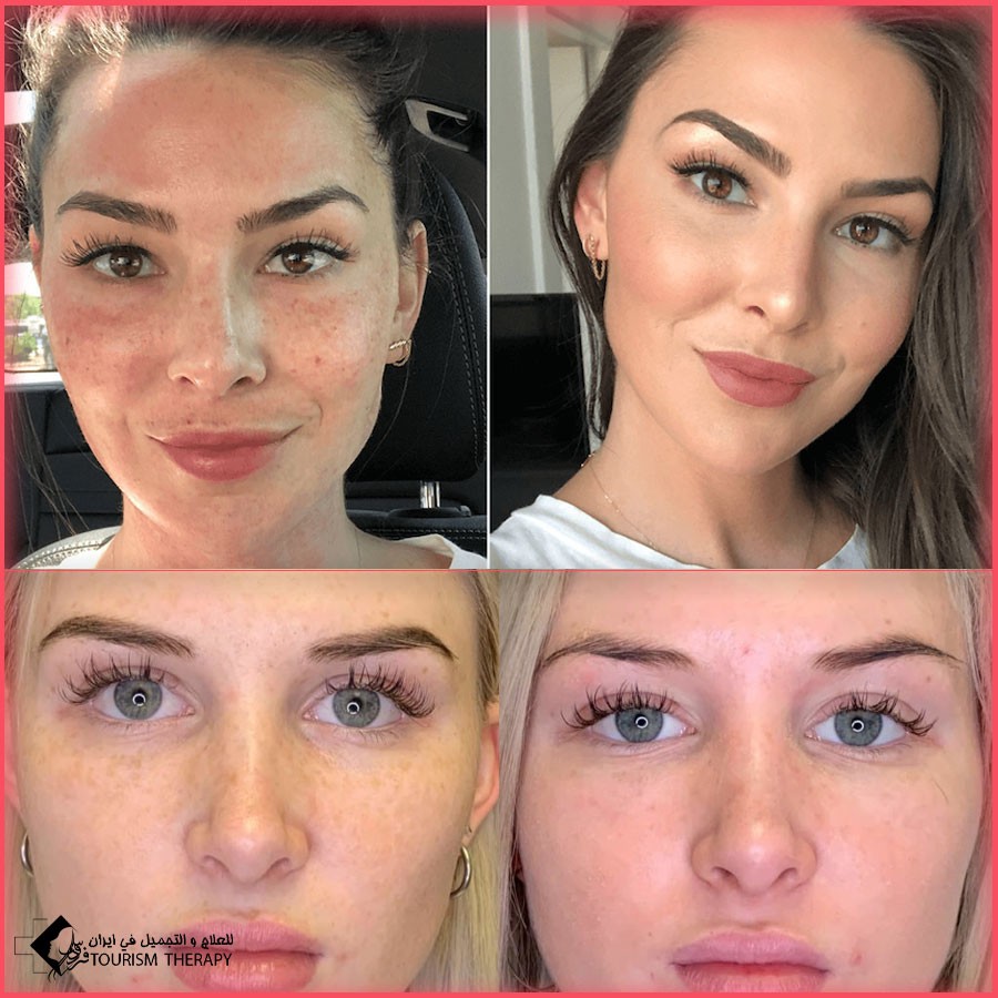 PRP skin treatment Shiraz.Iran بلازما الوجه في شيراز