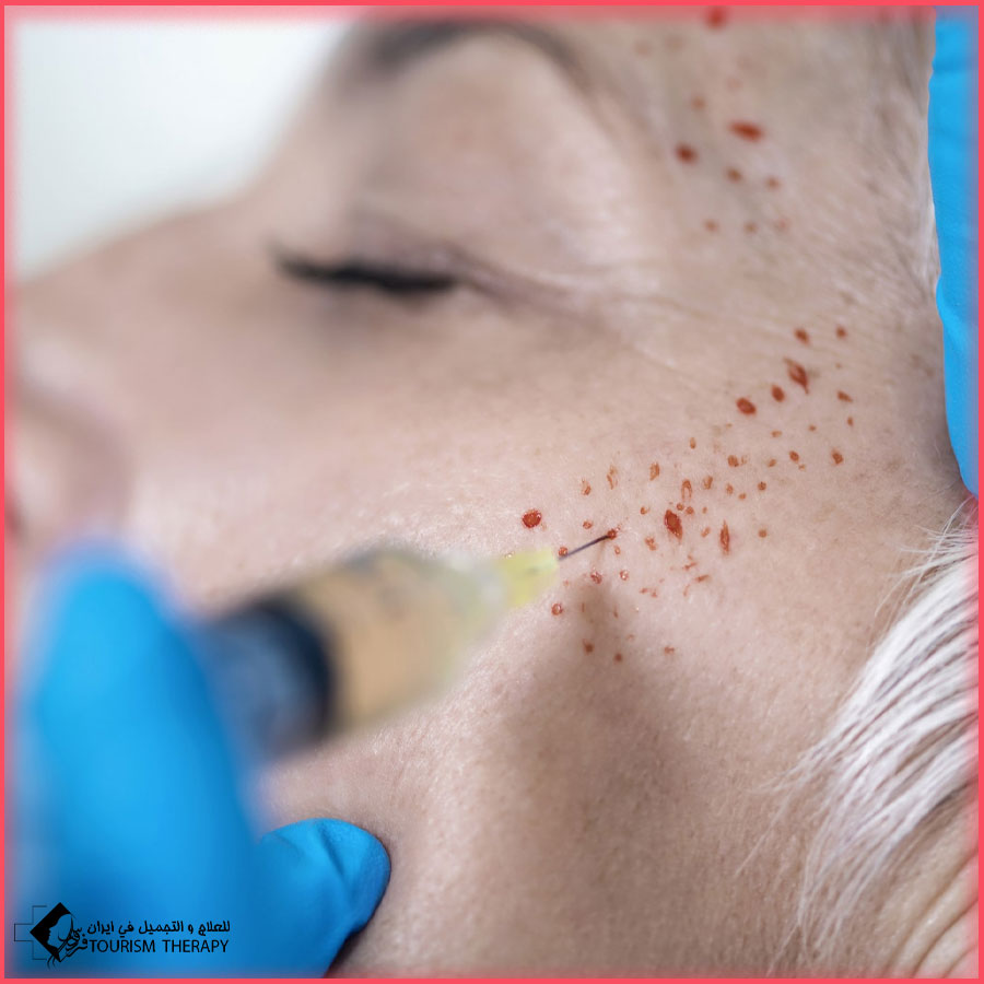 PRP skin treatment Shiraz بلازما الوجه في شيراز