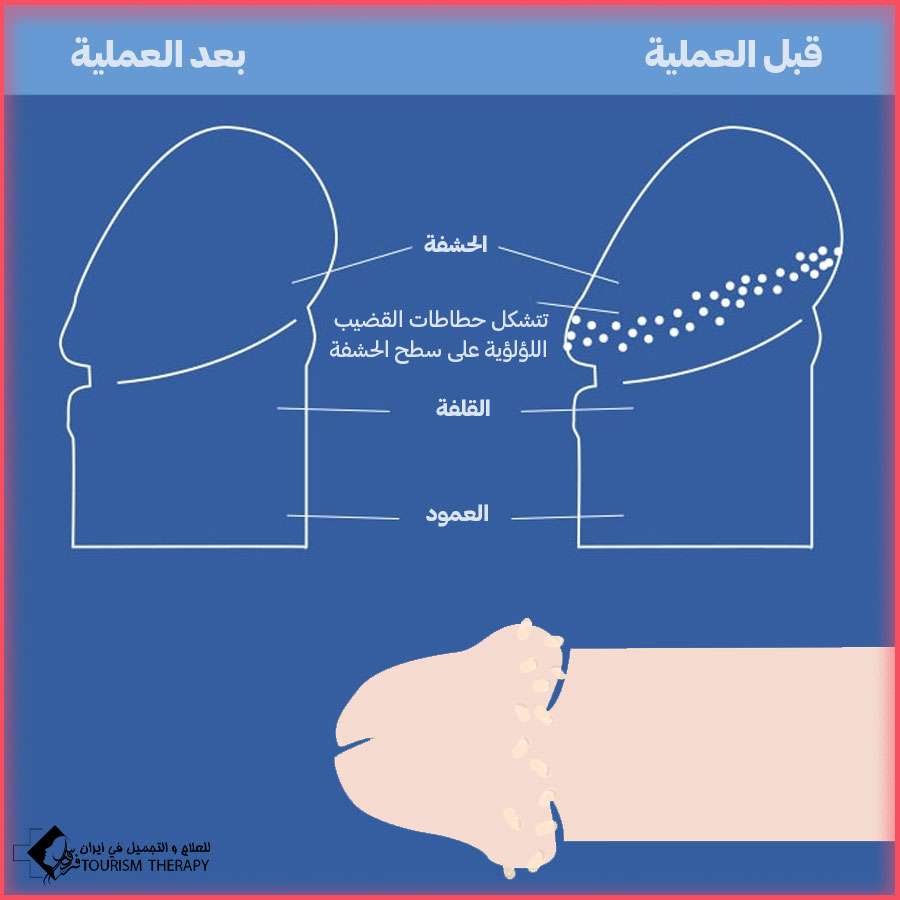 Pearly penile papules After Surgery in Mashhad علاج حطاطات القضيب اللؤلؤية في مشهد