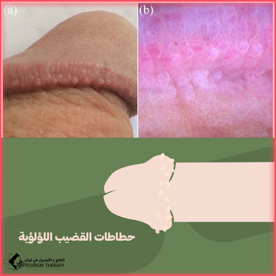 Pearly penile papules Treatment Mashhad علاج حطاطات القضيب اللؤلؤية في مشهد