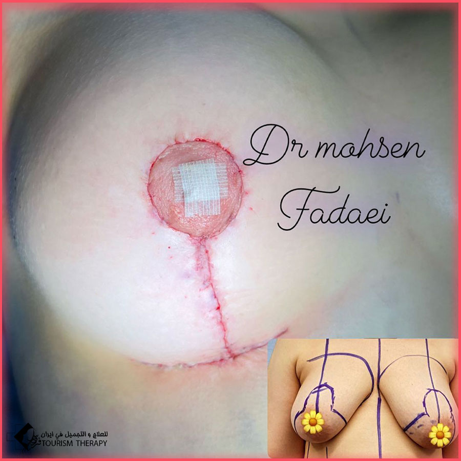 Periareolar Breast Lift dr fadaei عملية رفع محيط الحلمة Periareolar Breast Lift