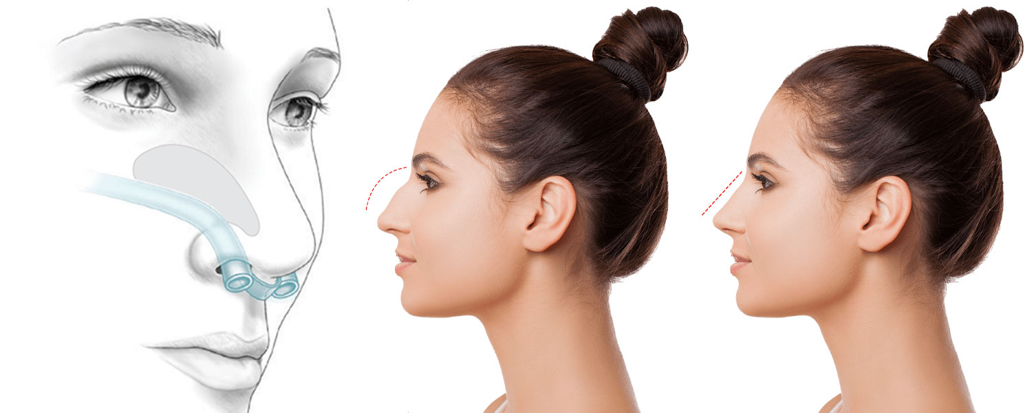 تجميل الأنف بدون تامبون 4 تجميل الأنف بدون تامبون