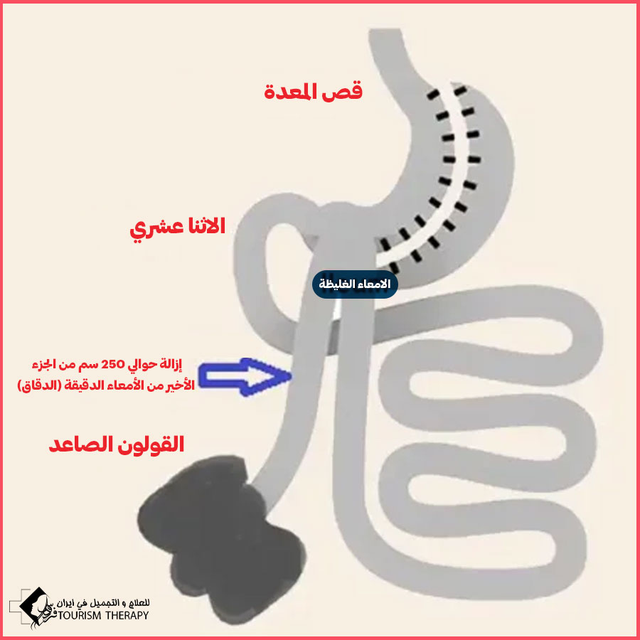 إجراءات عملية ثنائي تقسيم المعدة