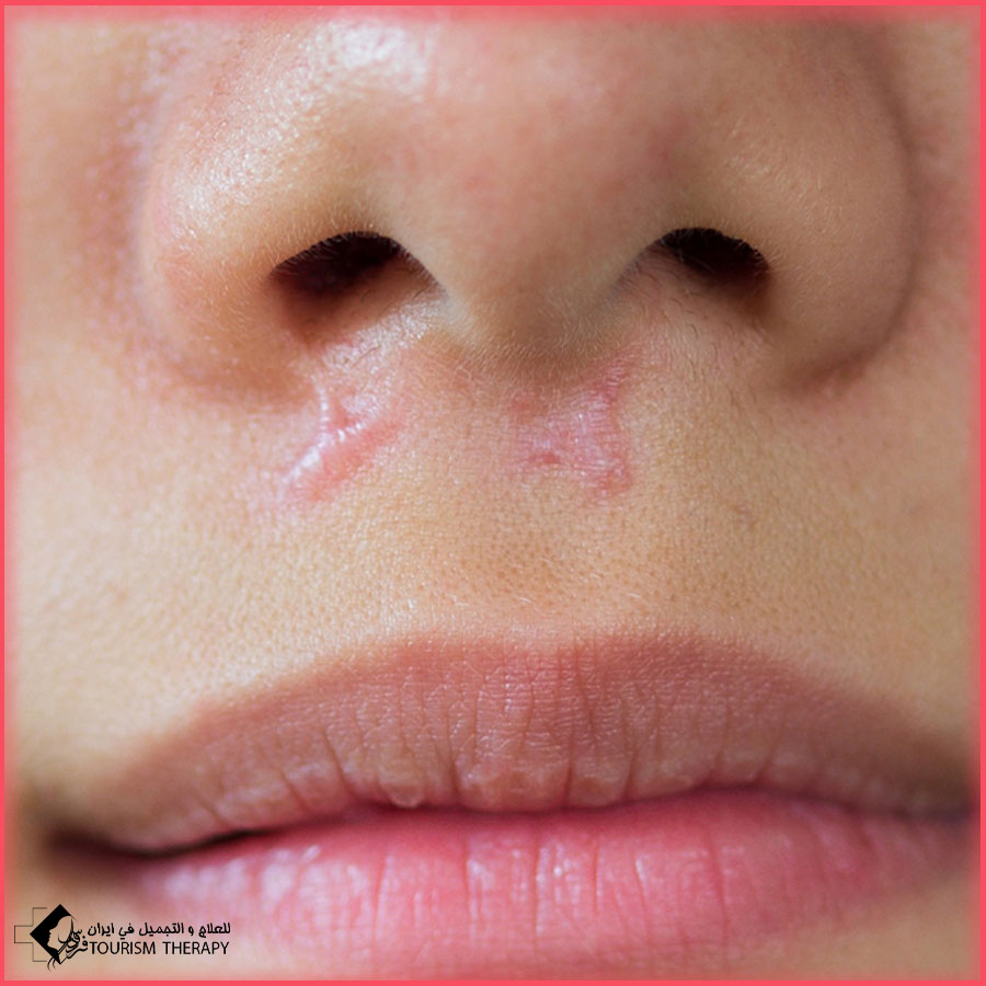 Scar Treatment Shiraz Iran علاج ندبات الوجه في شيراز