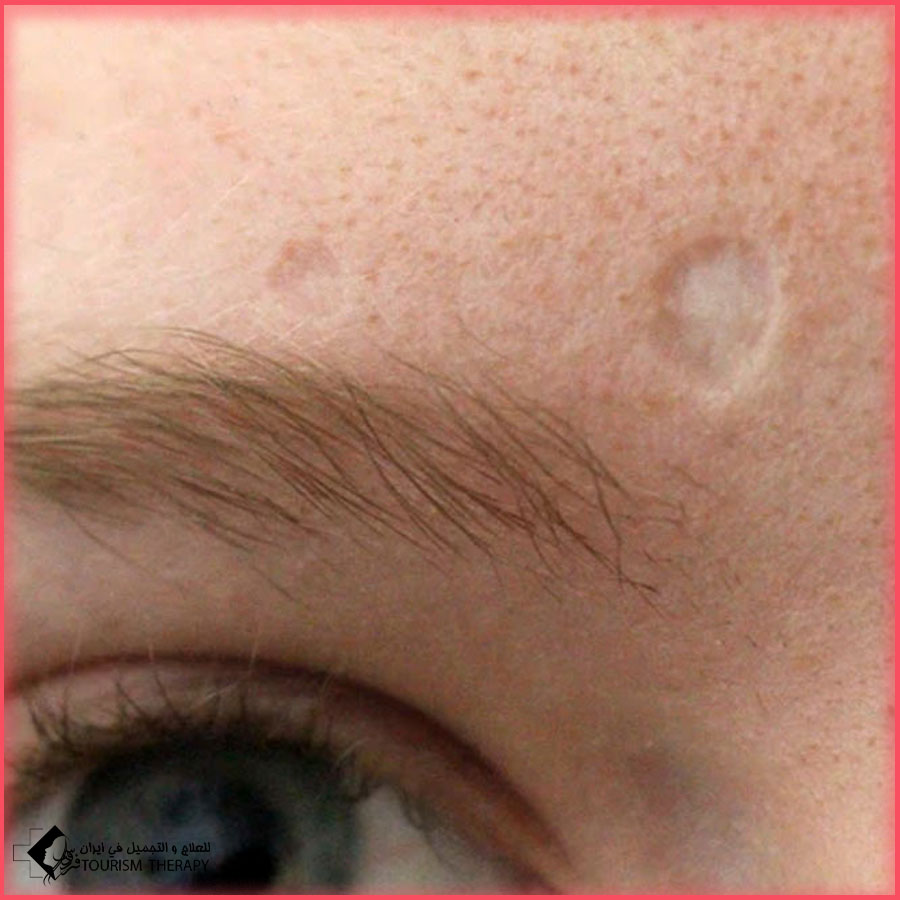 Scar Treatment Shiraz.Iran علاج ندبات الوجه في شيراز