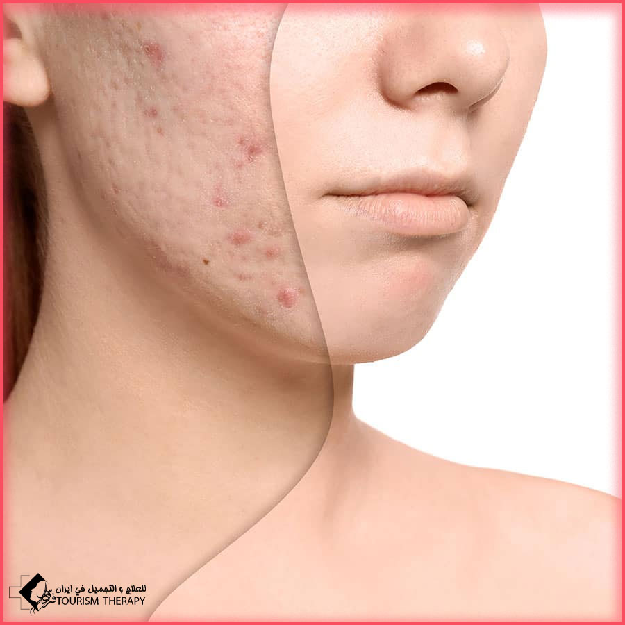 Scar Treatment in Shiraz علاج ندبات الوجه في شيراز