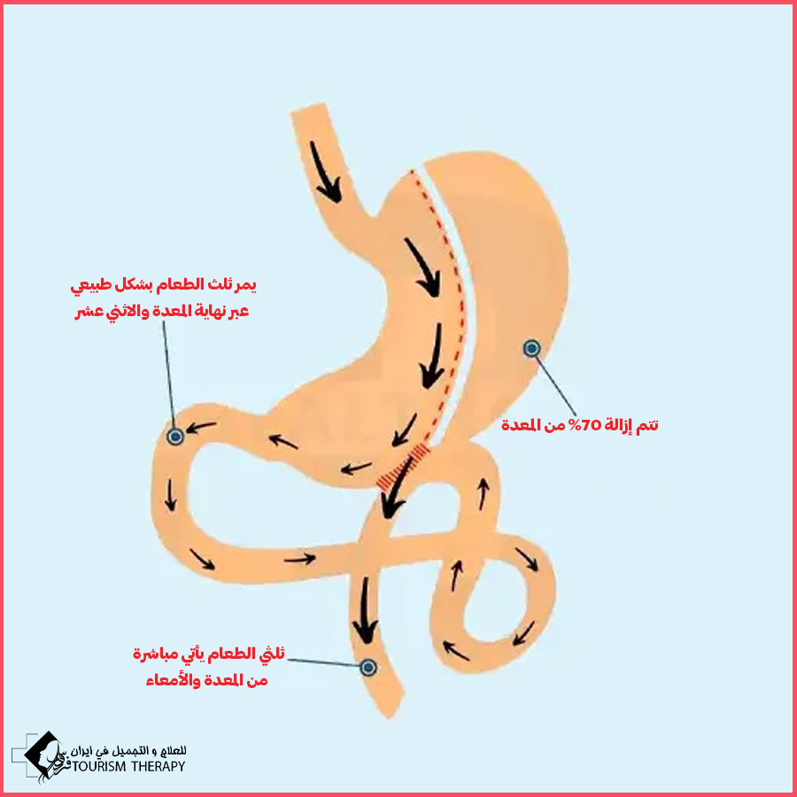 عملية ثنائي تقسيم المعدة