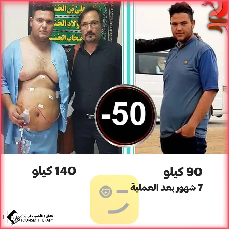 قبل وبعد عملية قص المعدة في مشهد مع الدكتور احمد نجاد رحيم