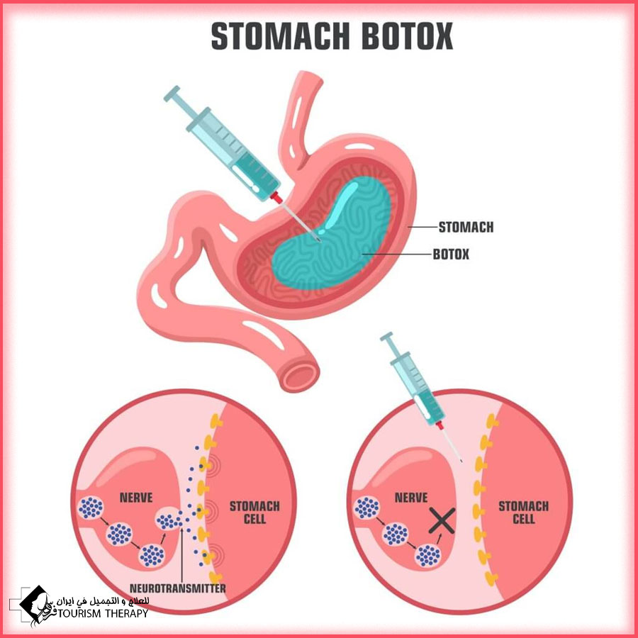 Stomach Botox Injection Tehran حقن بوتاكس المعدة في طهران