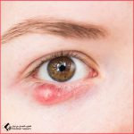 عملية شعيرة العين