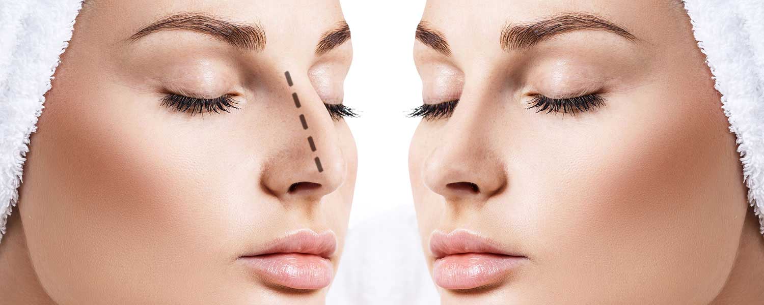 تجميل انحراف الأنف 5 تجميل انحراف الأنف