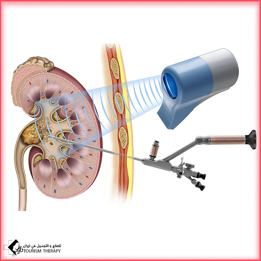 Transurethral Lithotripsy Surgery in Mashhad عملية تفتيت الحصى الداخلي في مشهد