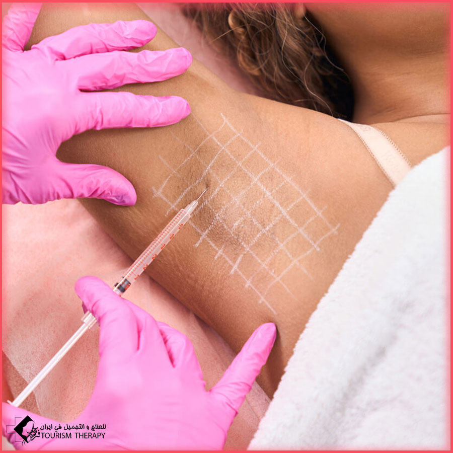 Under Arm Botox Shiraz حقن بوتاكس الإبط في شيراز
