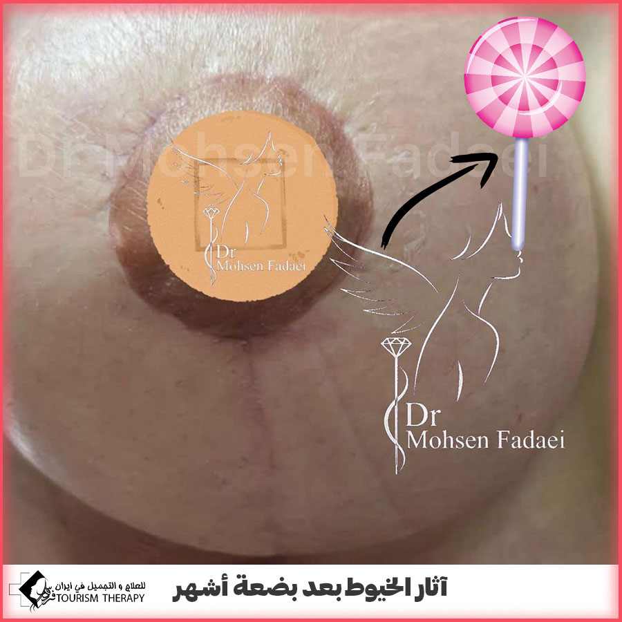 Vertical Breast Lift dr fadaei شد عمودي Vertical Breast Lift