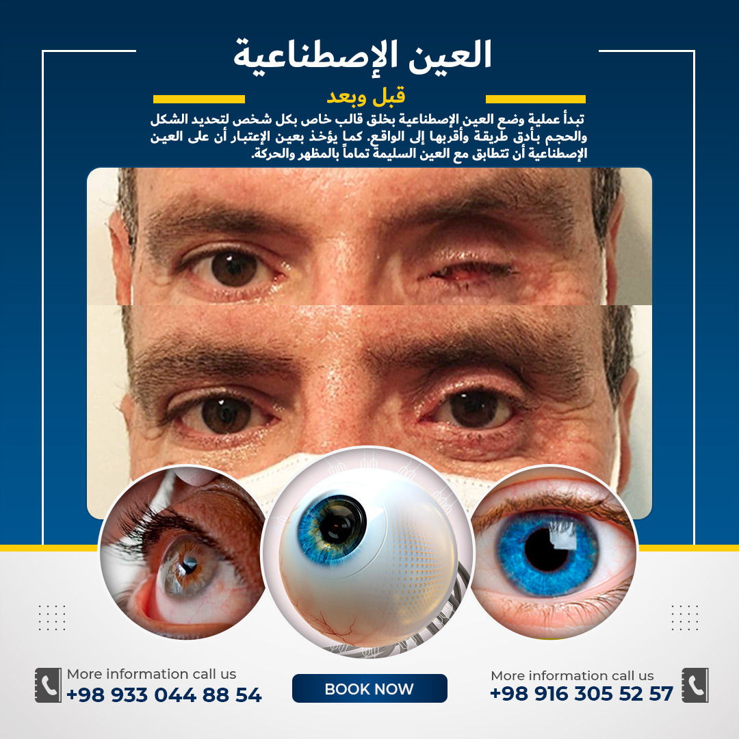 عين اصطناعية في شيراز