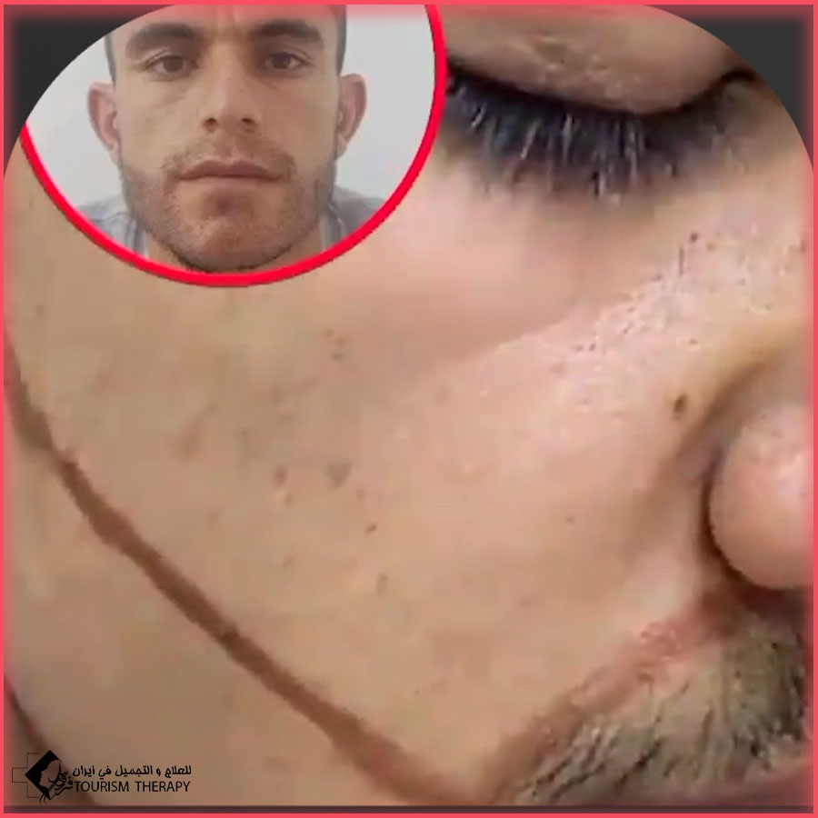 beard trans shid Tehran Iran زراعة اللحية في طهران