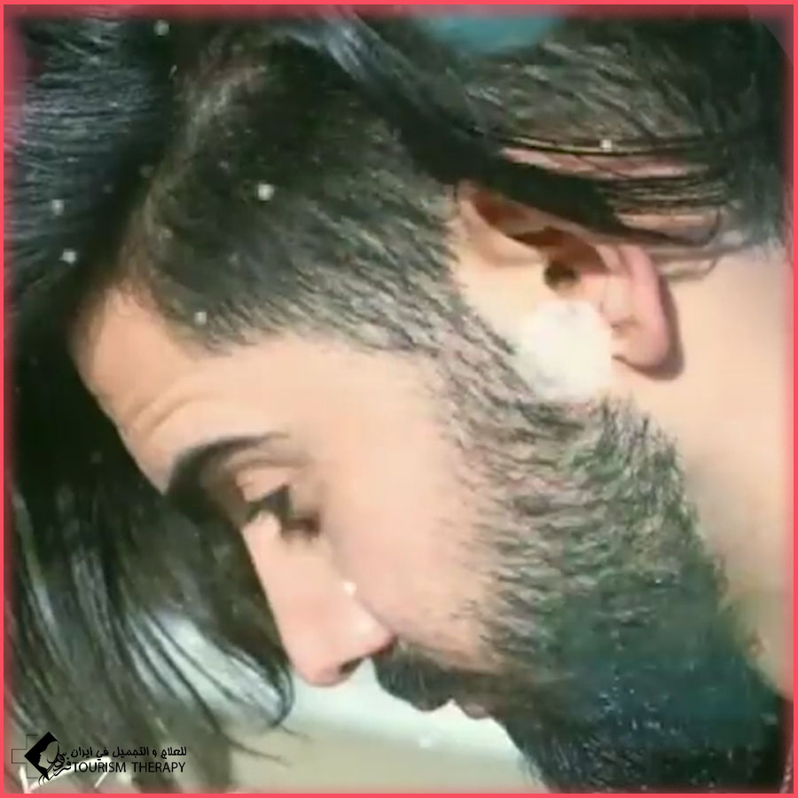 beard trans shid Tehran.Iran زراعة اللحية في طهران