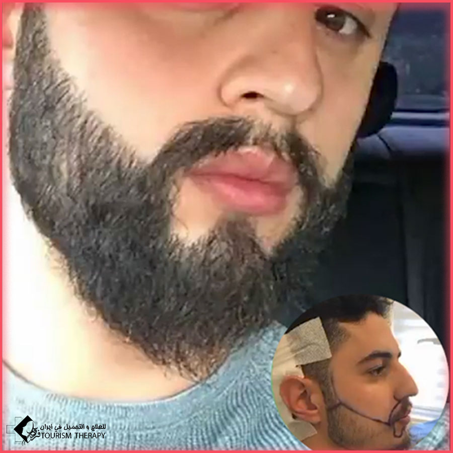 زراعة اللحية في طهران