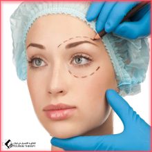تجميل الجفون