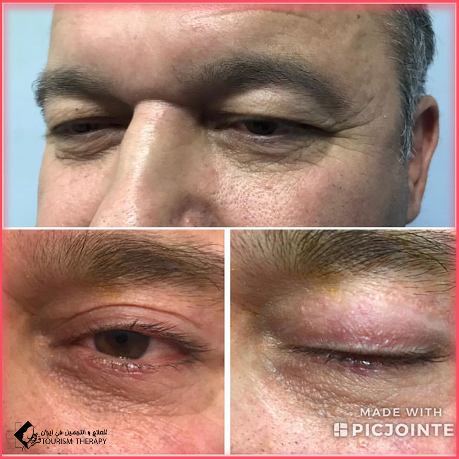 blepharoplasty dr Amali Hadi عملية تجميل الجفون في طهران مع الدكتور هادي آمالي