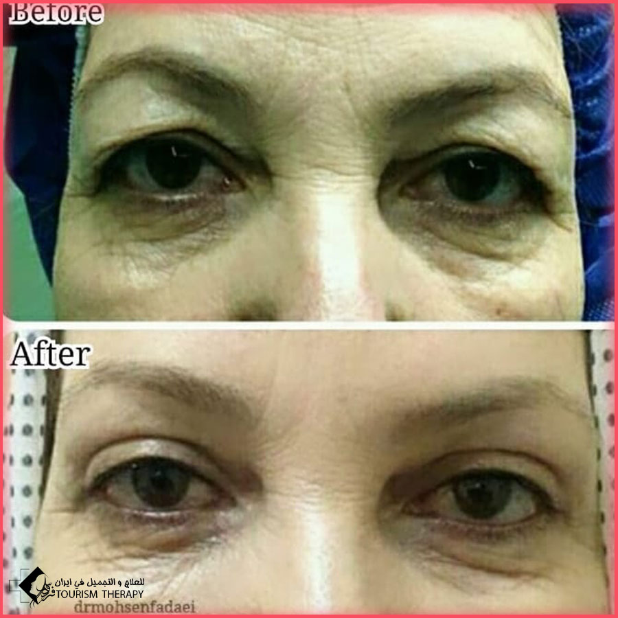 blepharoplasty dr fadaei Iran تجميل الجفون