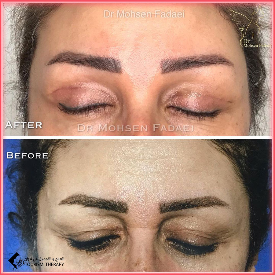 أفضل جراح تجميل الجفون في طهران - الدكتور محسن فدايي فوق التخصص