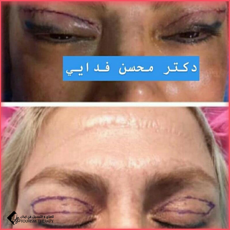 blepharoplasty dr fadaei تجميل الجفون