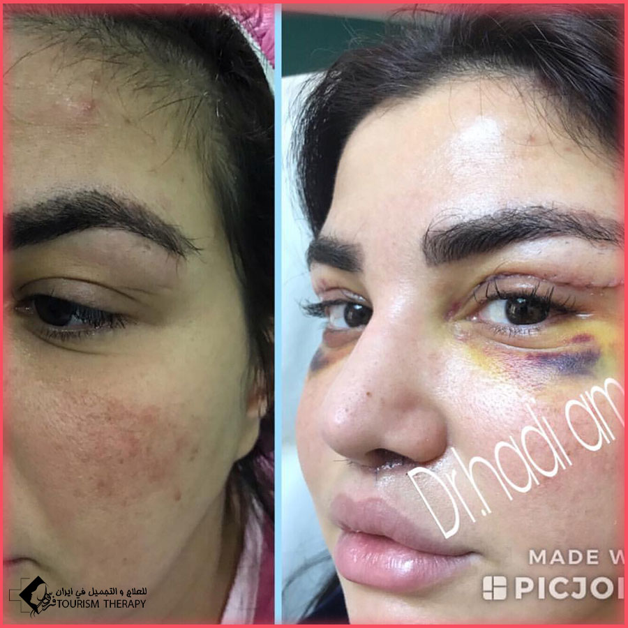 blepharoplasty dr.Hadi Amali عملية تجميل الجفون في طهران مع الدكتور هادي آمالي