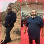 عملية تحويل مسار المعدة في شيراز مع الدكتور بابك حسيني