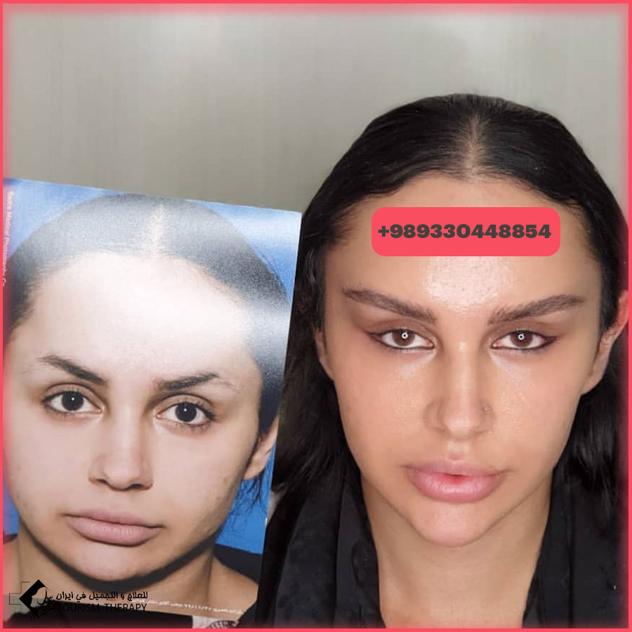 canthoplasty dr fadaei Tehran عملية عيون القطة في طهران