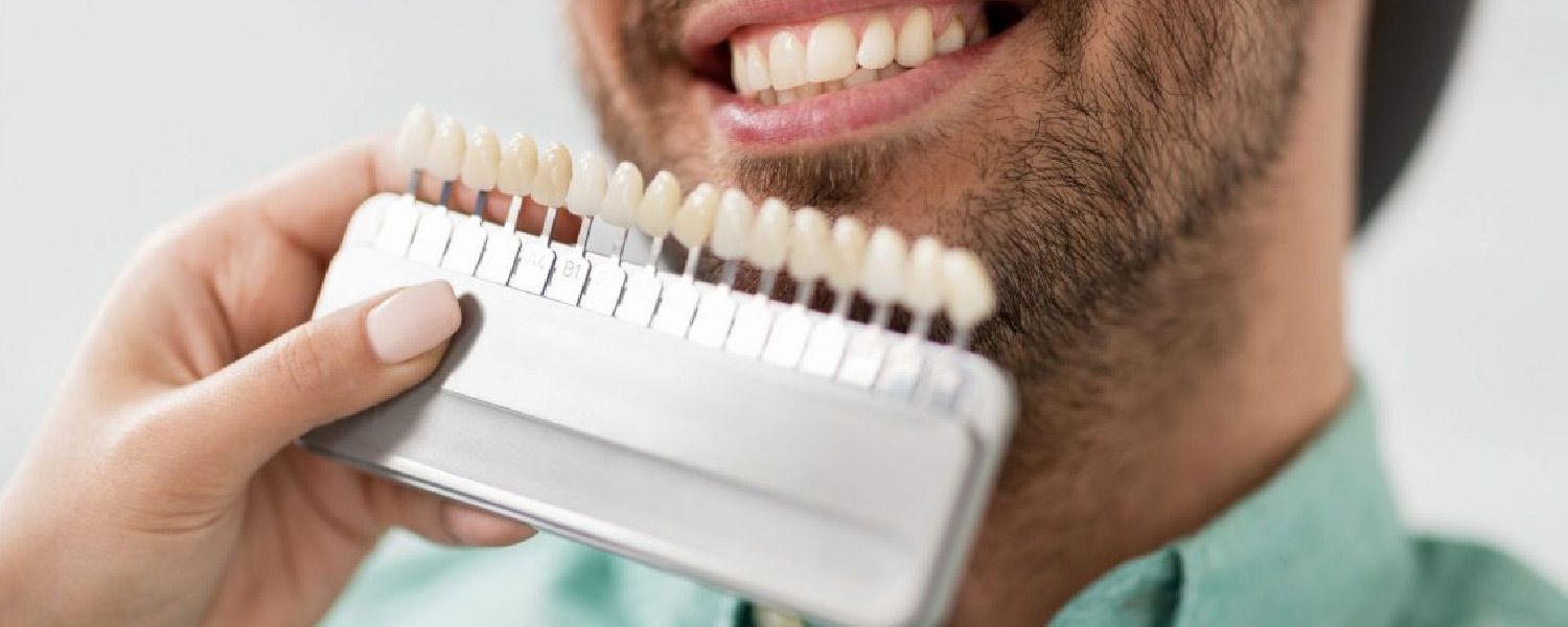الفرق بين صفائح السيراميك وقشرة الأسنان