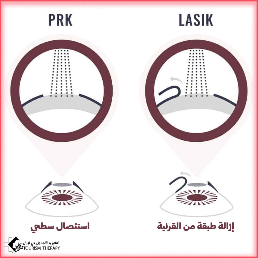 difference between prk and lasik Shiraz تصحيح النظر بتقنية SCHWIND AMARIS بطريقة TRANS-PRK