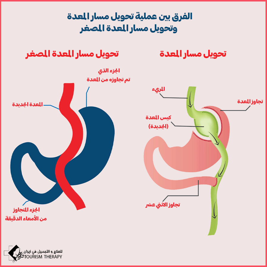 diffrence between bypass vs mini bypass surgery الفرق بين عملية تحويل مسار المعدة وتحويل مسار المعدة المصغر