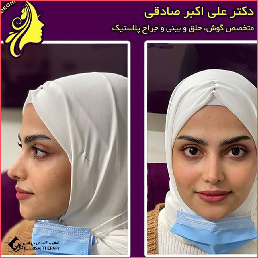 dr aliakbar sadeghi Rhinoplasty تجميل الأنف - الدكتور علي اكبر صادقي