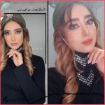 تجميل الأنف في مشهد مع الدكتورة فرشتة عصمتي نيا