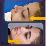 تجميل الأنف في مشهد مع الدكتور ايرج وكيلي
