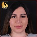 تجميل الأنف في مشهد مع الدكتور سيد مسعود ناصري