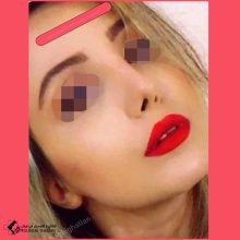 تجميل الأنف | الدكتور علي حقيقتيان